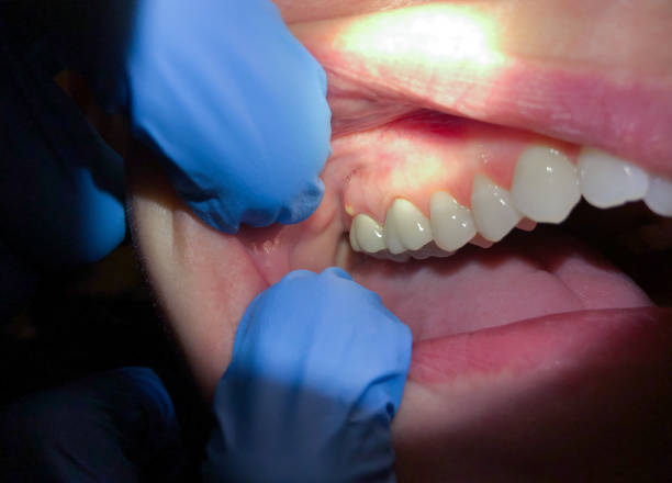Best Emergency Wisdom Tooth Extraction in Scottdale, GA